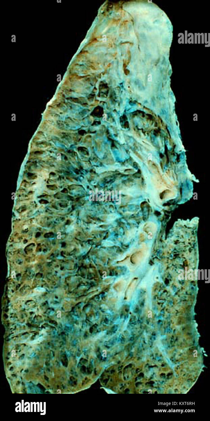 Subpleural hi-res stock photography and images - Alamy