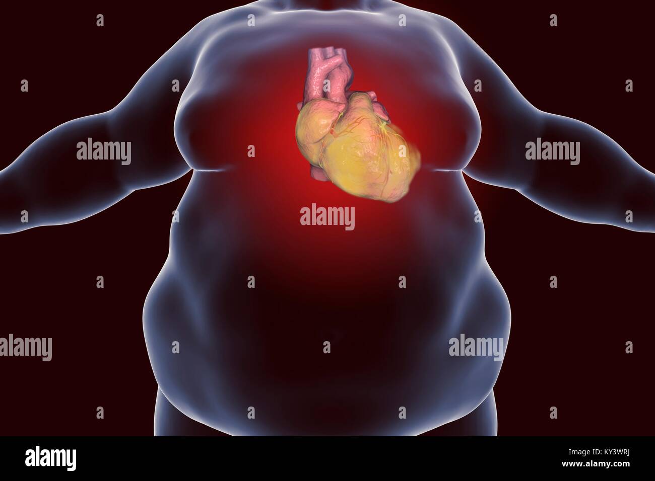 Computer illustration of a fatty heart in an overweight man. Stock Photo