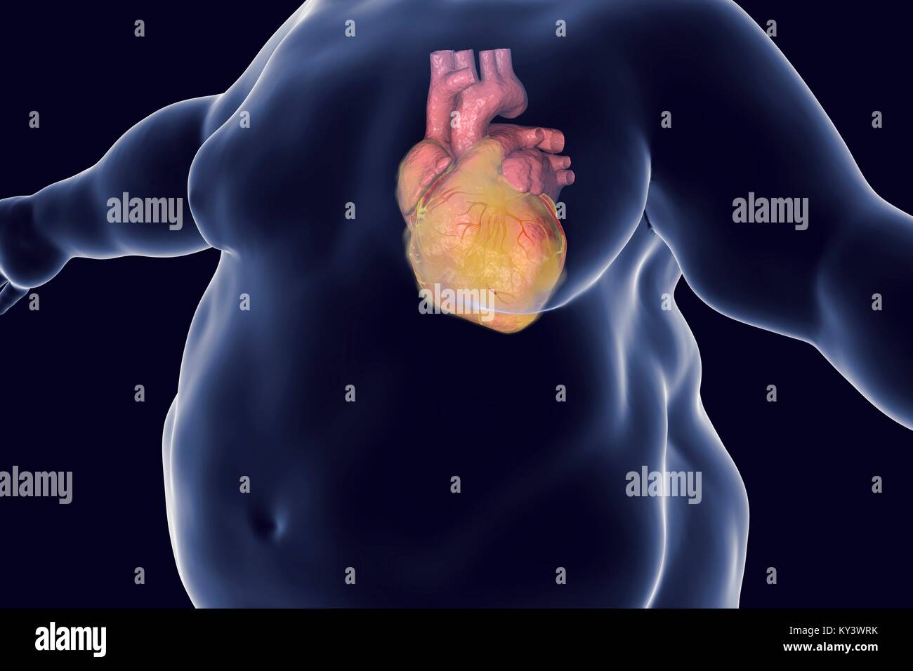 Computer illustration of a fatty heart in an overweight man. Stock Photo