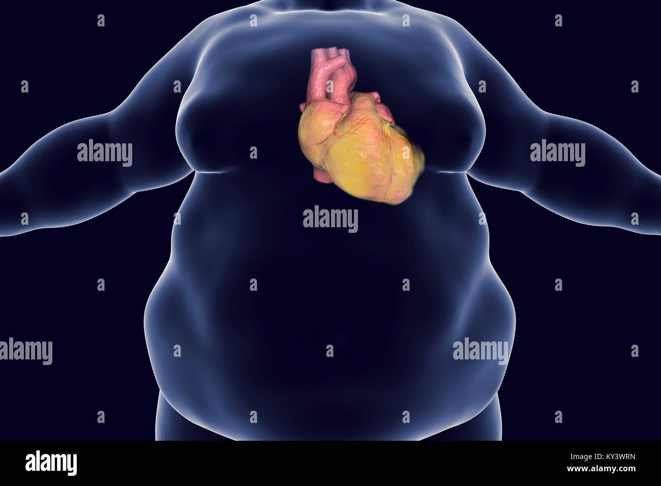 Obese man's heart, computer illustration. Stock Photo