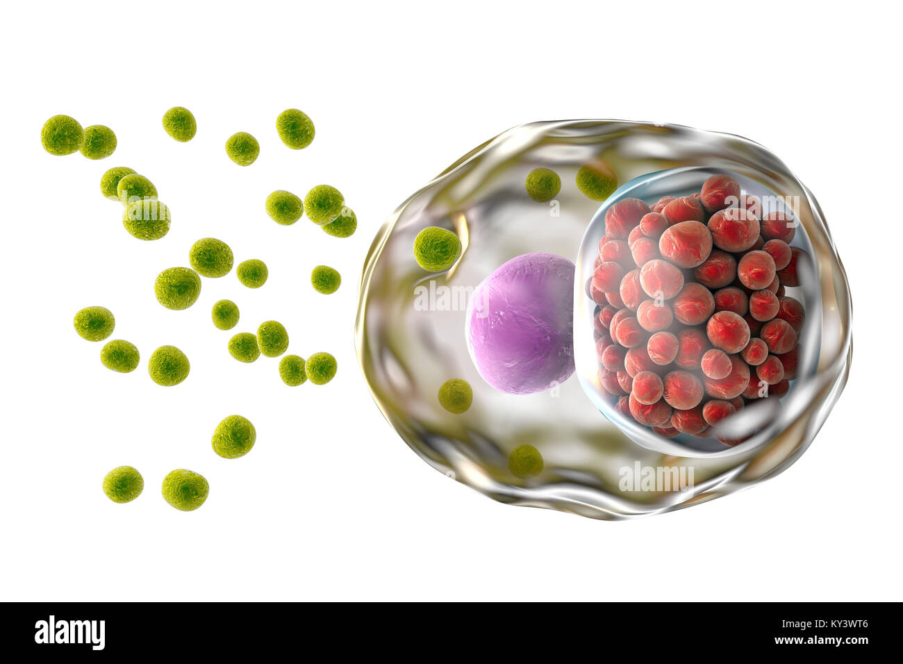Chlamydia infection. Computer illustration of a cell infected with Chlamydia trachomatis bacteria. Elementary bodies (EBs, small green spheres), the non-replicating infectious form of the bacteria are seen outside the host cell. EBs infect the cell and are transformed into reticulate bodies (RB), which are replicating form. RBs are seen as a group of small red spheres near the nucleus (purple) of the cell. Chlamydia is a sexually transmitted infection that can go undetected causing infertility. It also causes the eye disease trachoma, which can lead to blindness. Stock Photo