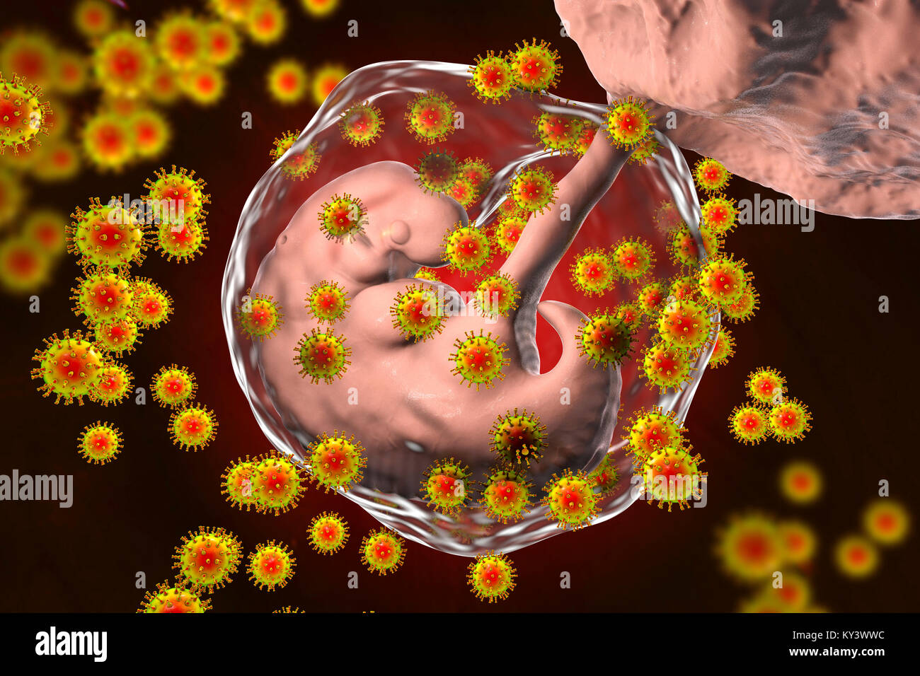 Human immunodeficiency viruses (HIV) infecting human embryo, conceptual illustration. The embryo is 4 weeks old. Stock Photo