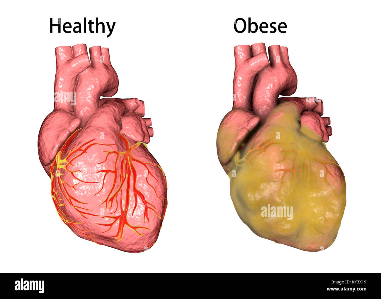 Heart of a healthy person (left) and an overweight person (right, obese heart), computer illustration. Stock Photo