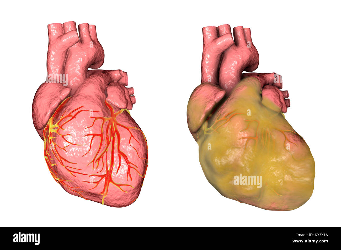 Healthy Heart Left And Heart With Left Ventricular Hypertrophy And Fat Layer Right Computer Illustration Stock Photo Alamy