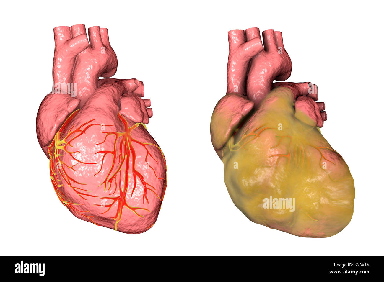 Healthy heart (left) and heart with left ventricular hypertrophy and fat layer (right), computer illustration. Stock Photo