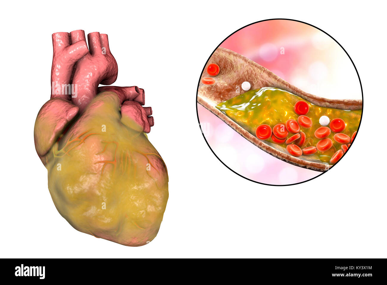 Computer illustration of a fatty heart and a coronary artery narrowed by a fatty plaque. Stock Photo