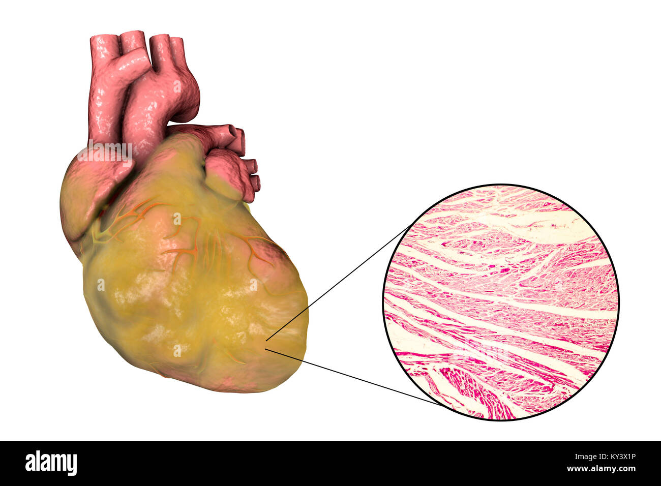Illustration of a fatty heart with left ventricular hypertrophy and light micrograph of hypertrophic cardiac tissue. Stock Photo