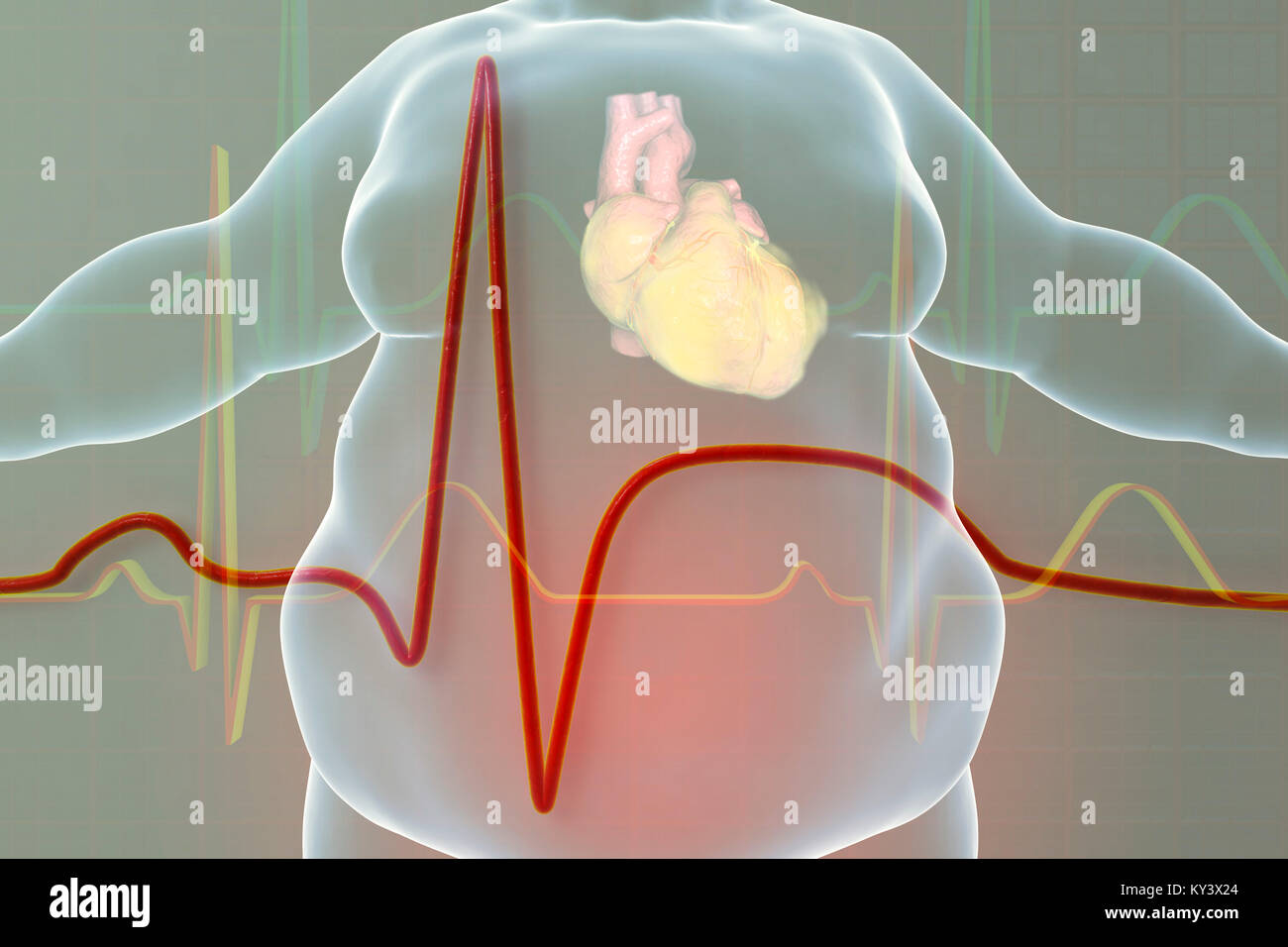 Heart attack in obese man. Conceptual illustration showing a fatty heart in an overweight man and an electrocardiogram with signs of myocardial infarction (heart attack). Stock Photo
