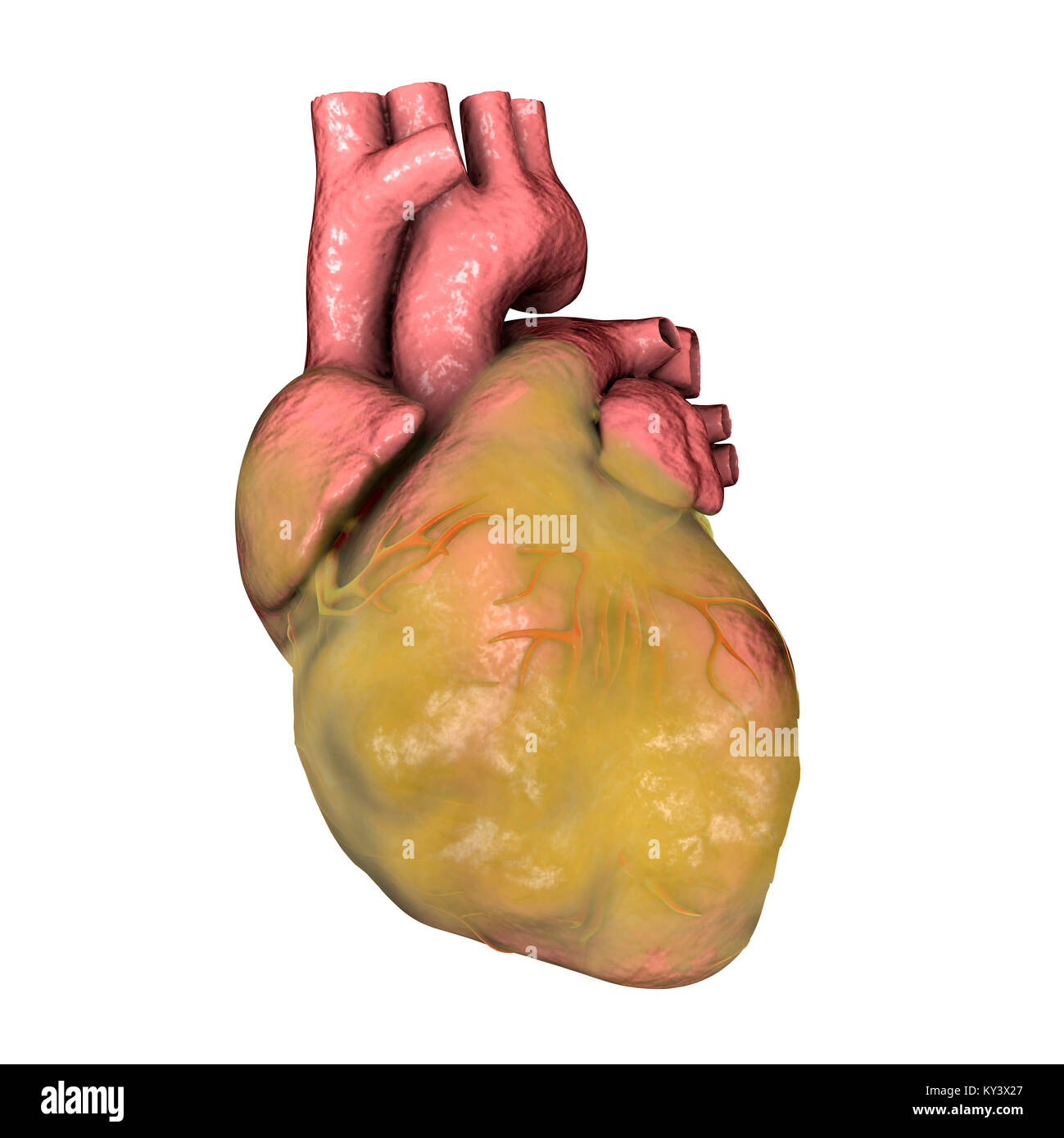 Fatty heart, computer illustration. Stock Photo