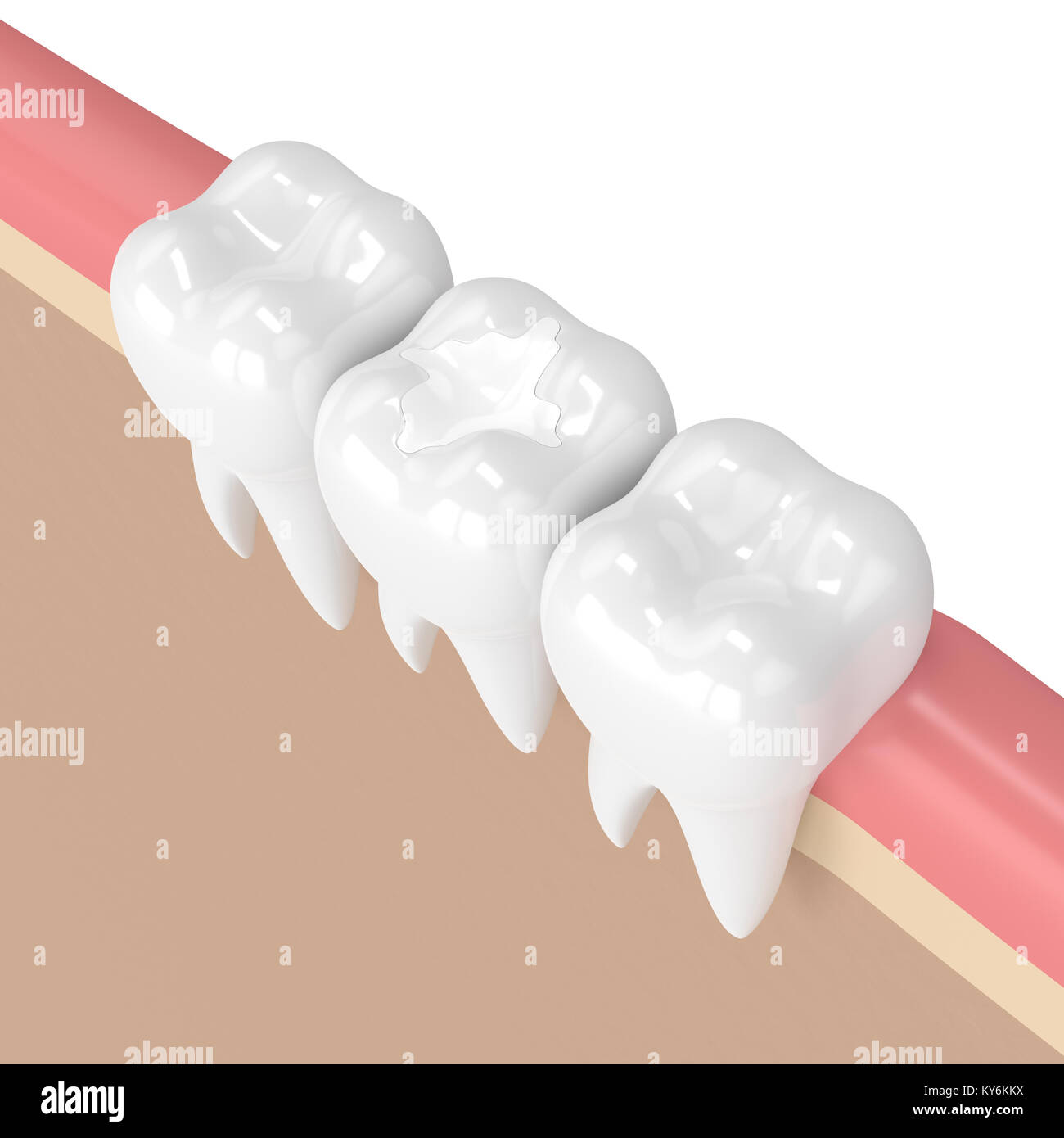 3d render of teeth with dental composite filling in gums Stock Photo