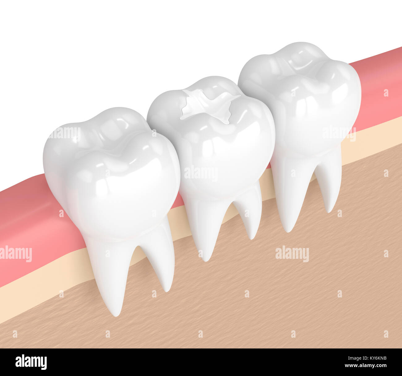 3d render of teeth with dental composite filling in gums Stock Photo