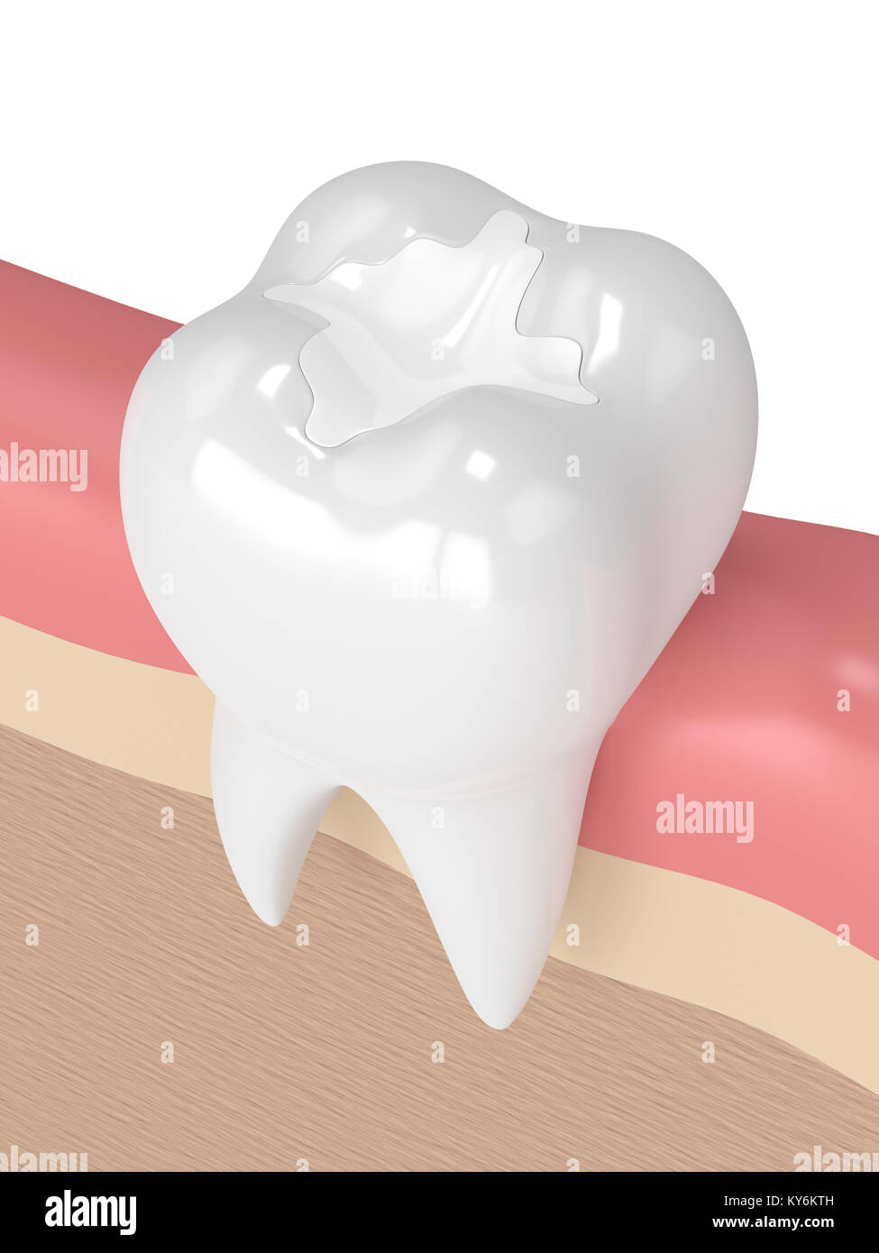 3d render of tooth with dental composite filling in gums Stock Photo