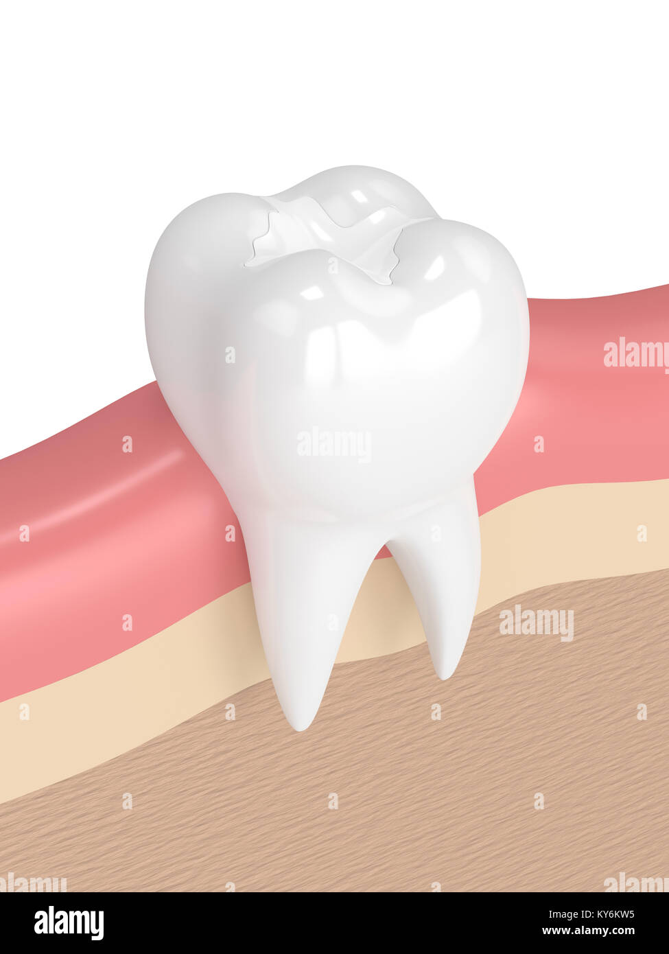 3d render of tooth with dental composite filling in gums Stock Photo