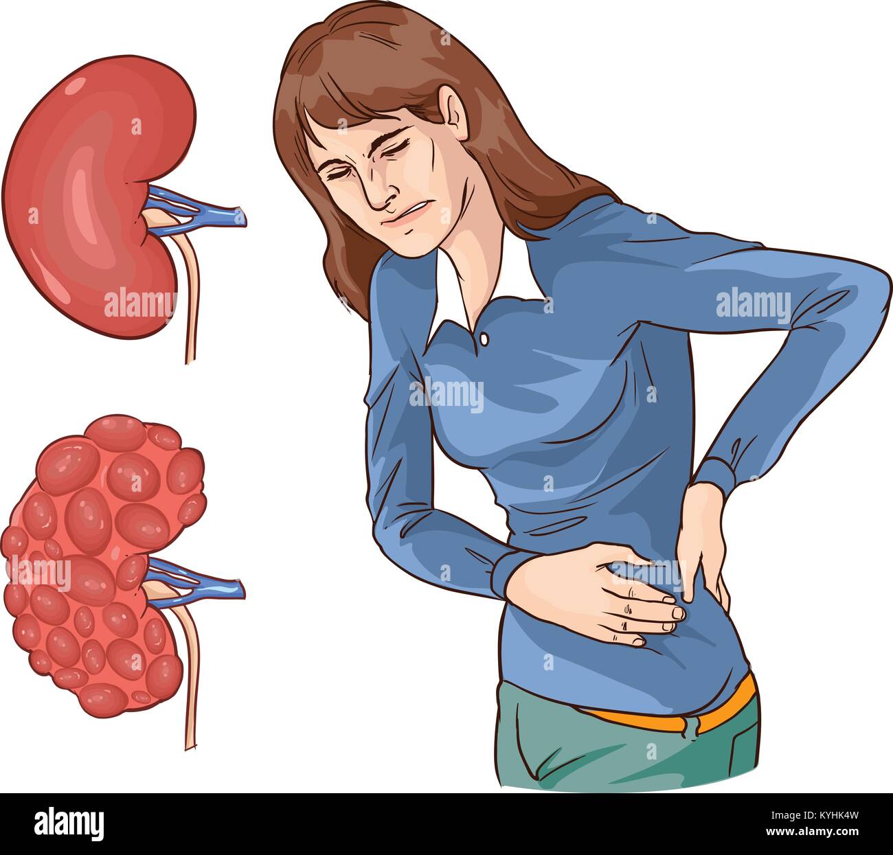 Vector Illustration Of A Chronic Kidney Disease Stock Vector Image ...