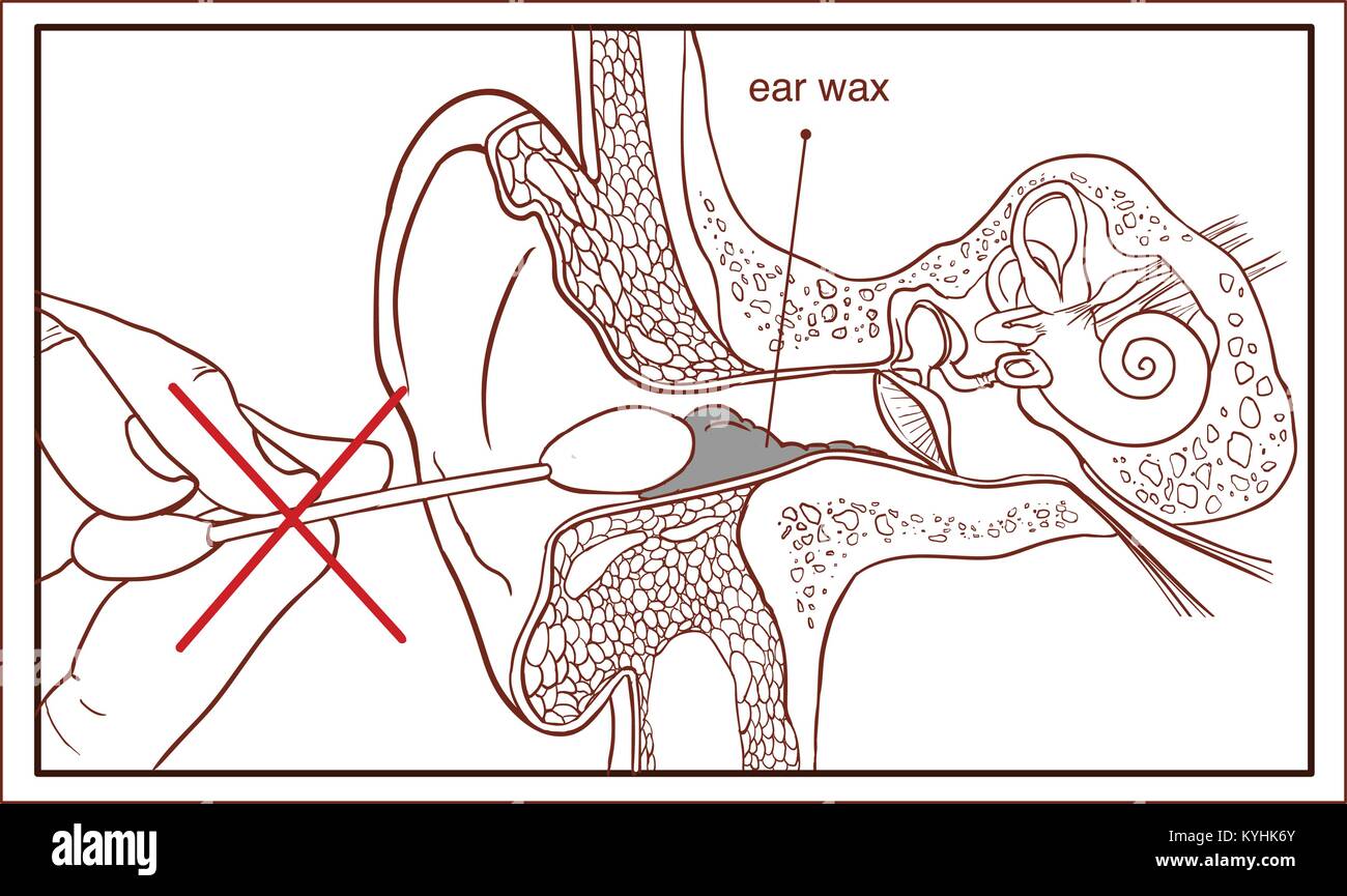 Ear wax anatomy hires stock photography and images Alamy