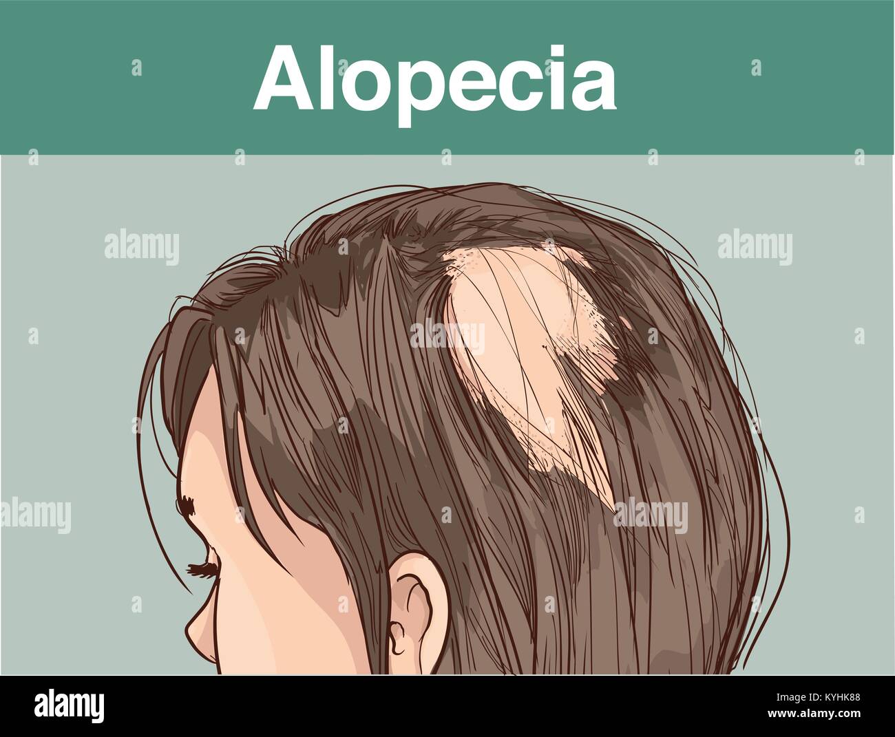 vector illustration of aFemale alopecia Stock Vector