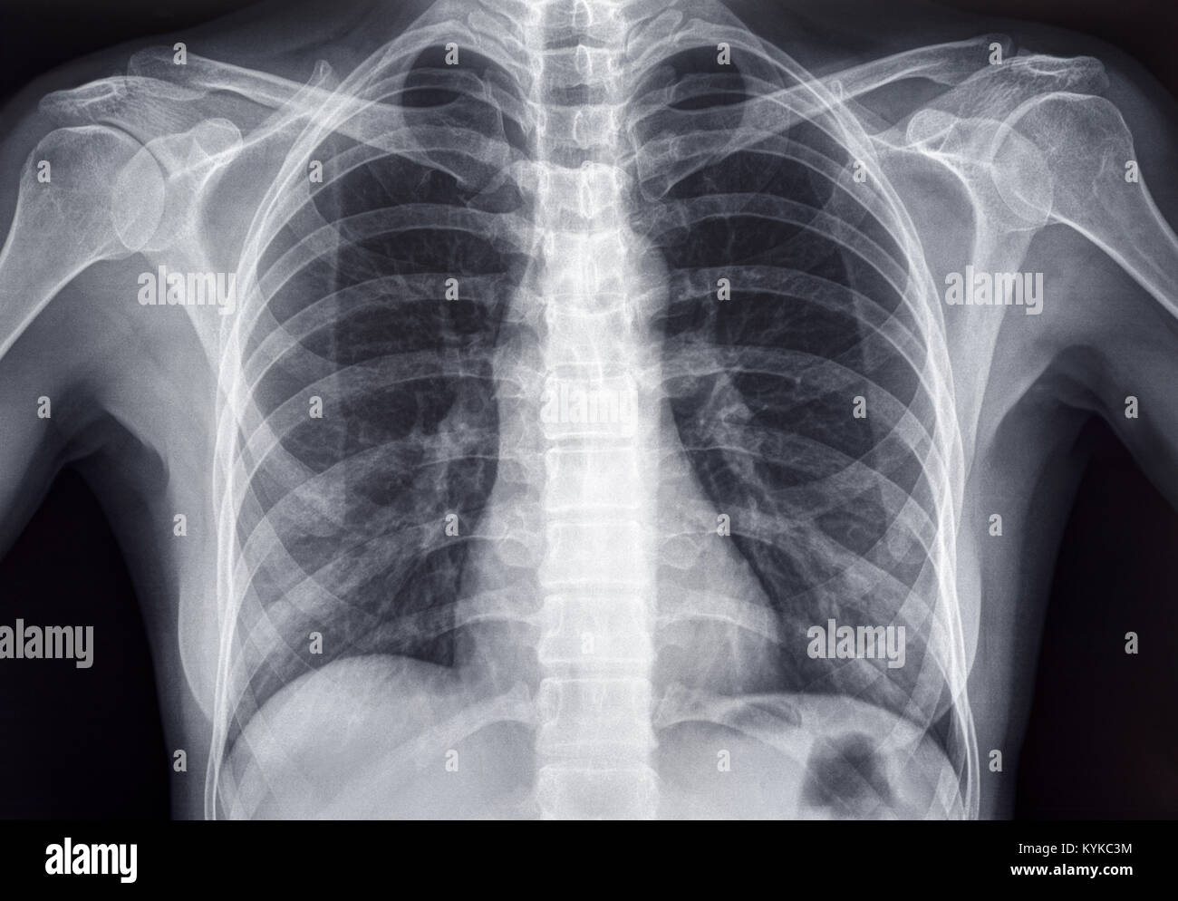 Chest X-ray of an Adult Female Human Stock Photo