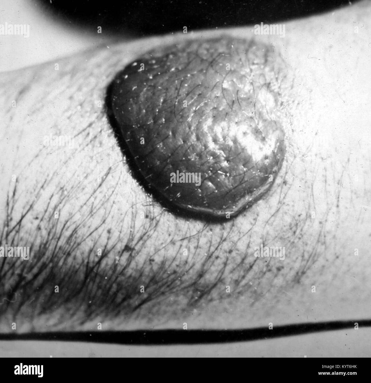 A Mustard gas injury, ARP training slide, WW2 Stock Photo