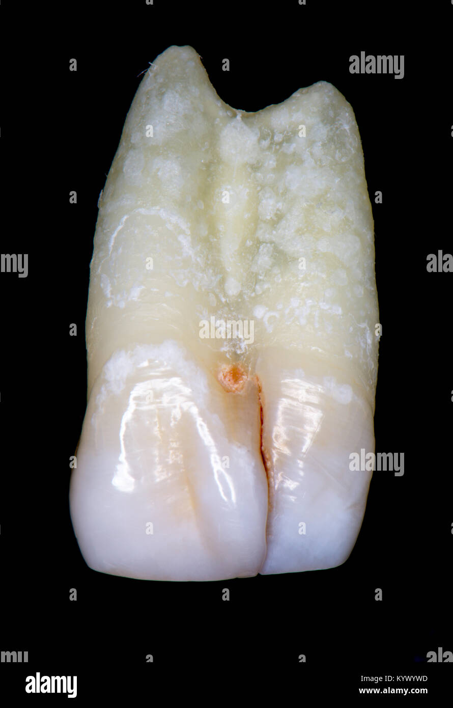 tooth fusion or gemination or concrescence Stock Photo Alamy