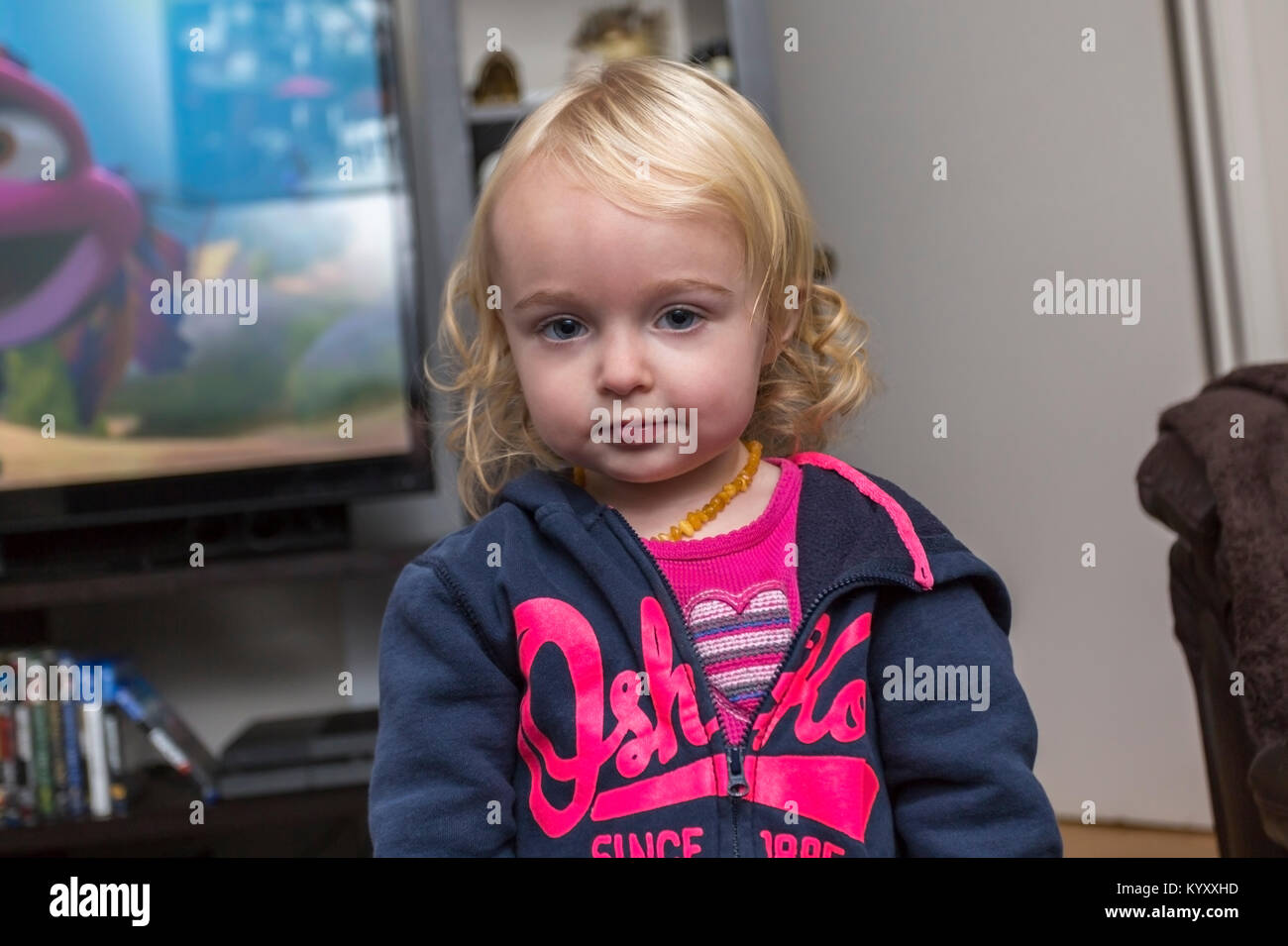 portrait of a 2 year old girl with hemangioma on her lip. Hemangioma grows during the first year and recedes over time Stock Photo