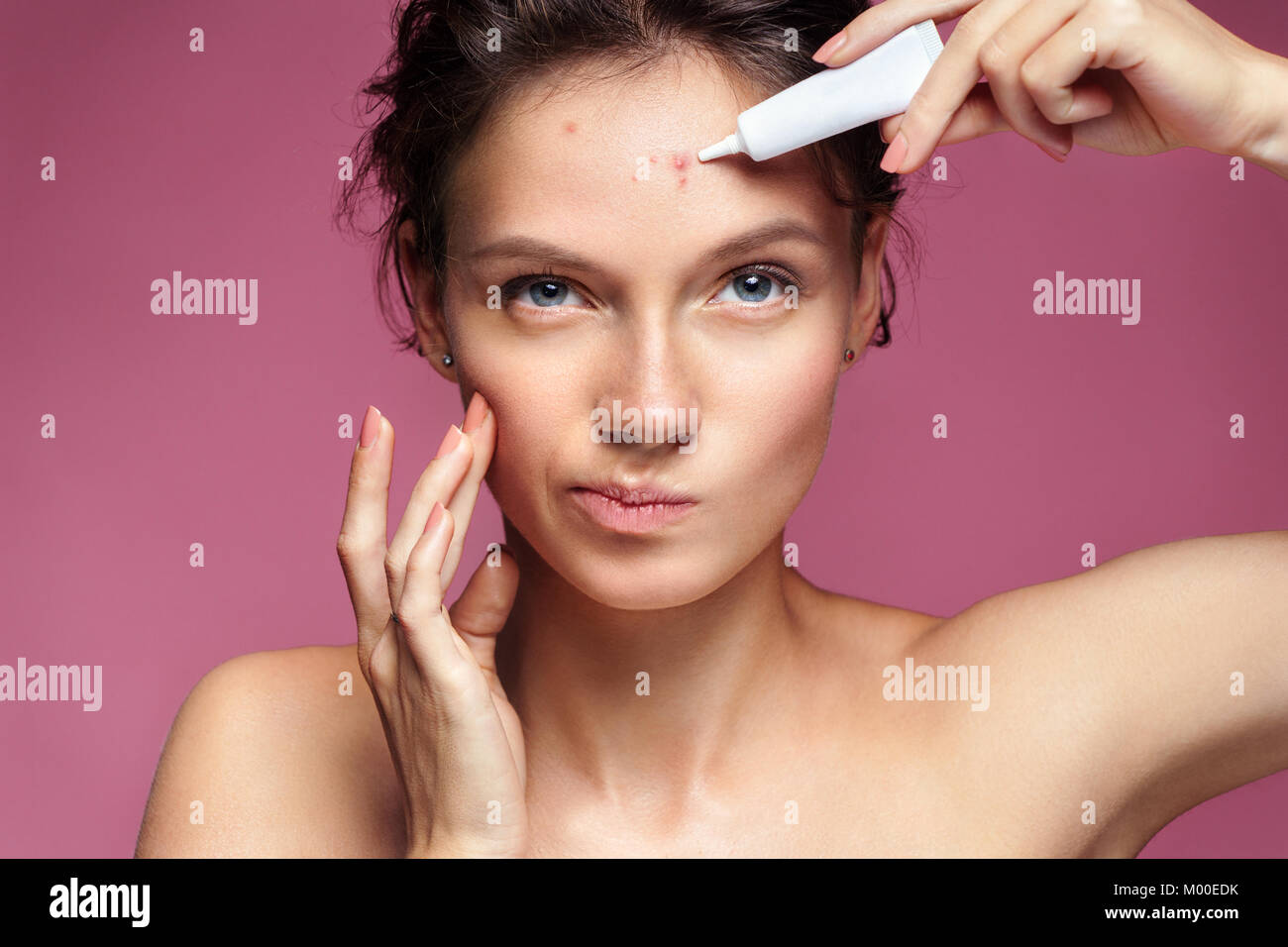 Scowling girl pointing at her acne and appling treatment cream. Photo of young girl with problem skin on pink background. Skin care concept Stock Photo