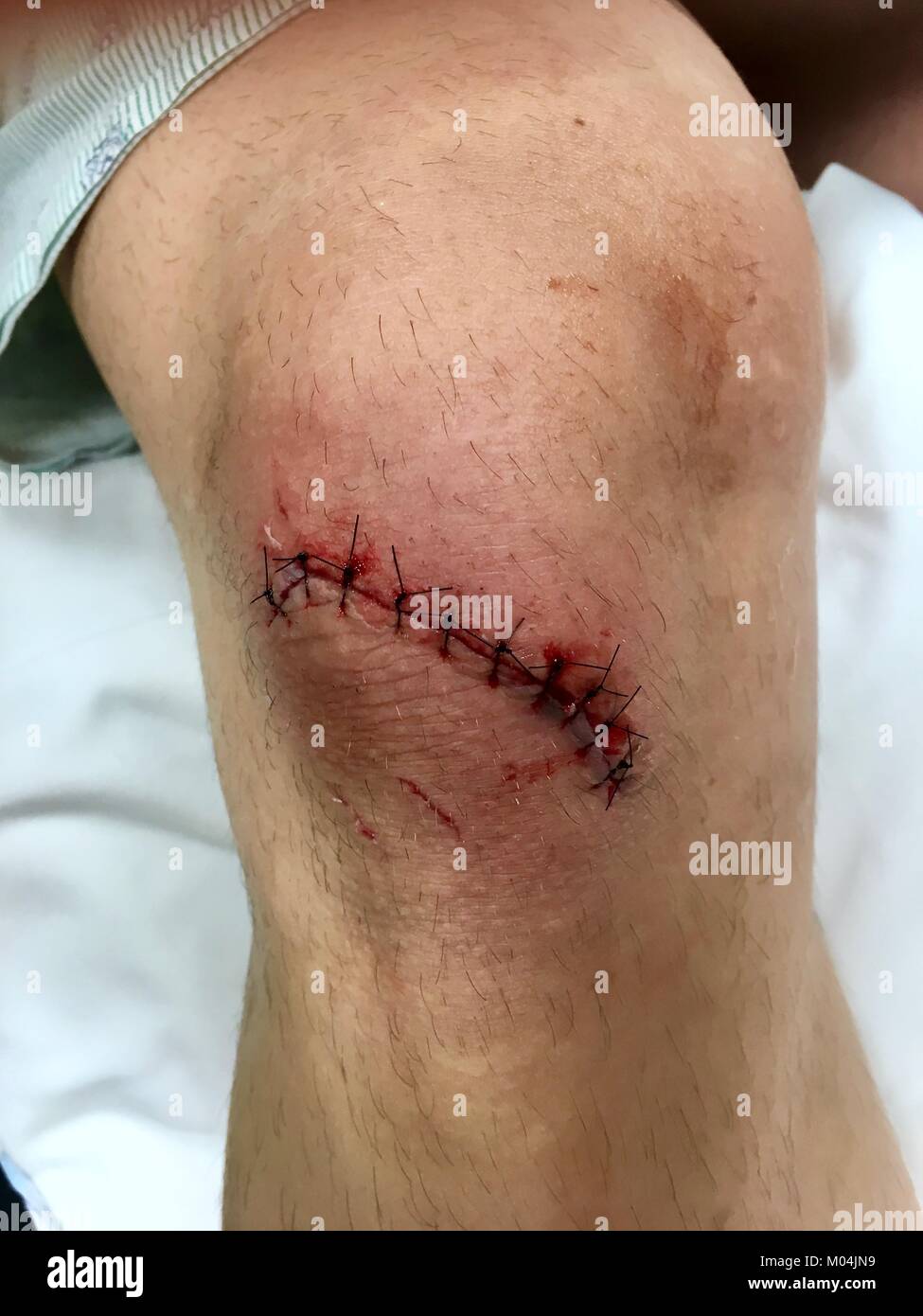 Knee laceration with stitches Stock Photo