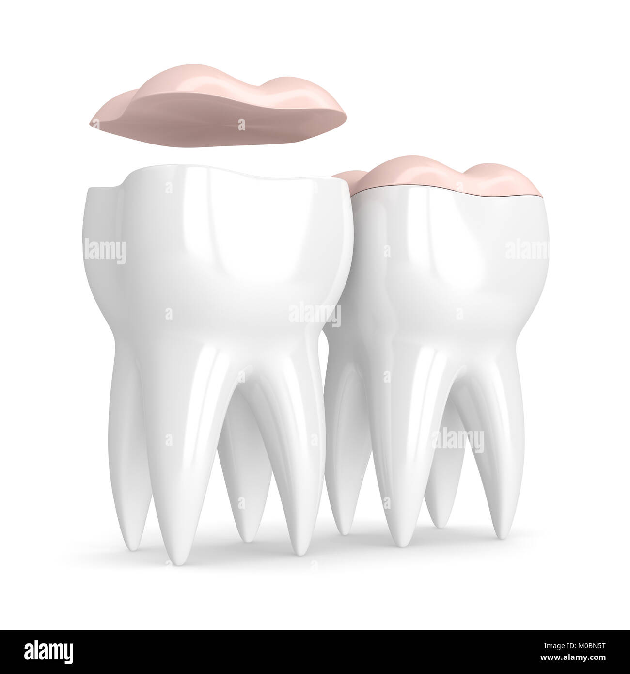 3d render of teeth with dental onlay over white background Stock Photo ...