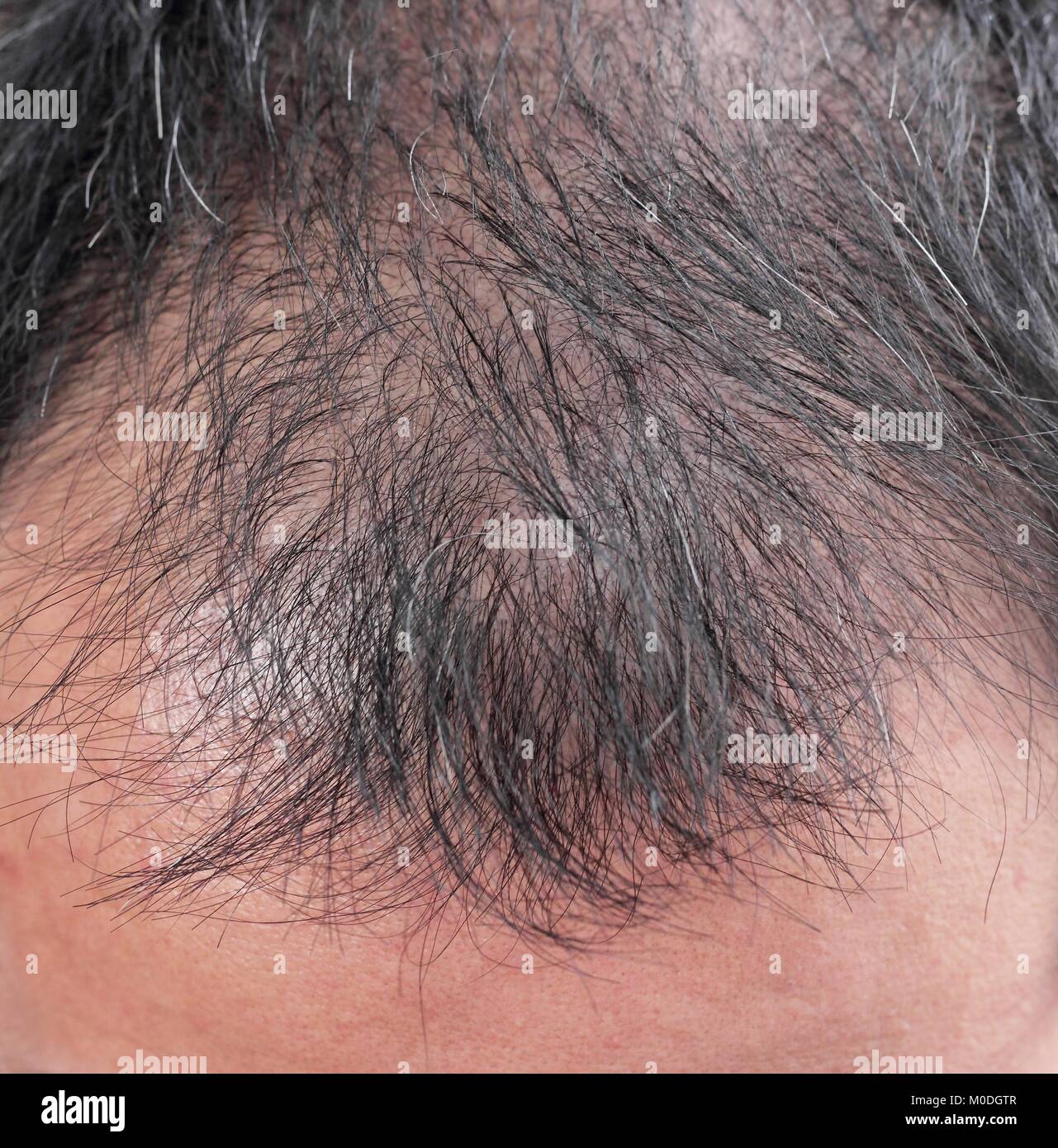 Point of focus lose one's hair glabrous baldy loss hairline men. Stock Photo
