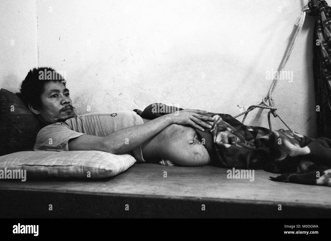 A landmine victim lies recovering post-surgery at the Mae Tao Clinic on the Thai-Burma border. Approximately 300 people per day receive free healthcare at the clinic, mostly being migrant workers and refugees who have fled across the border from Burma (Myanmar) to escape the desperate poverty and persecution from the ruling military regime. Healthcare is all but non-existent in Burma, where less than 2% of the GDP is spent on healthcare and education combined. Stock Photo