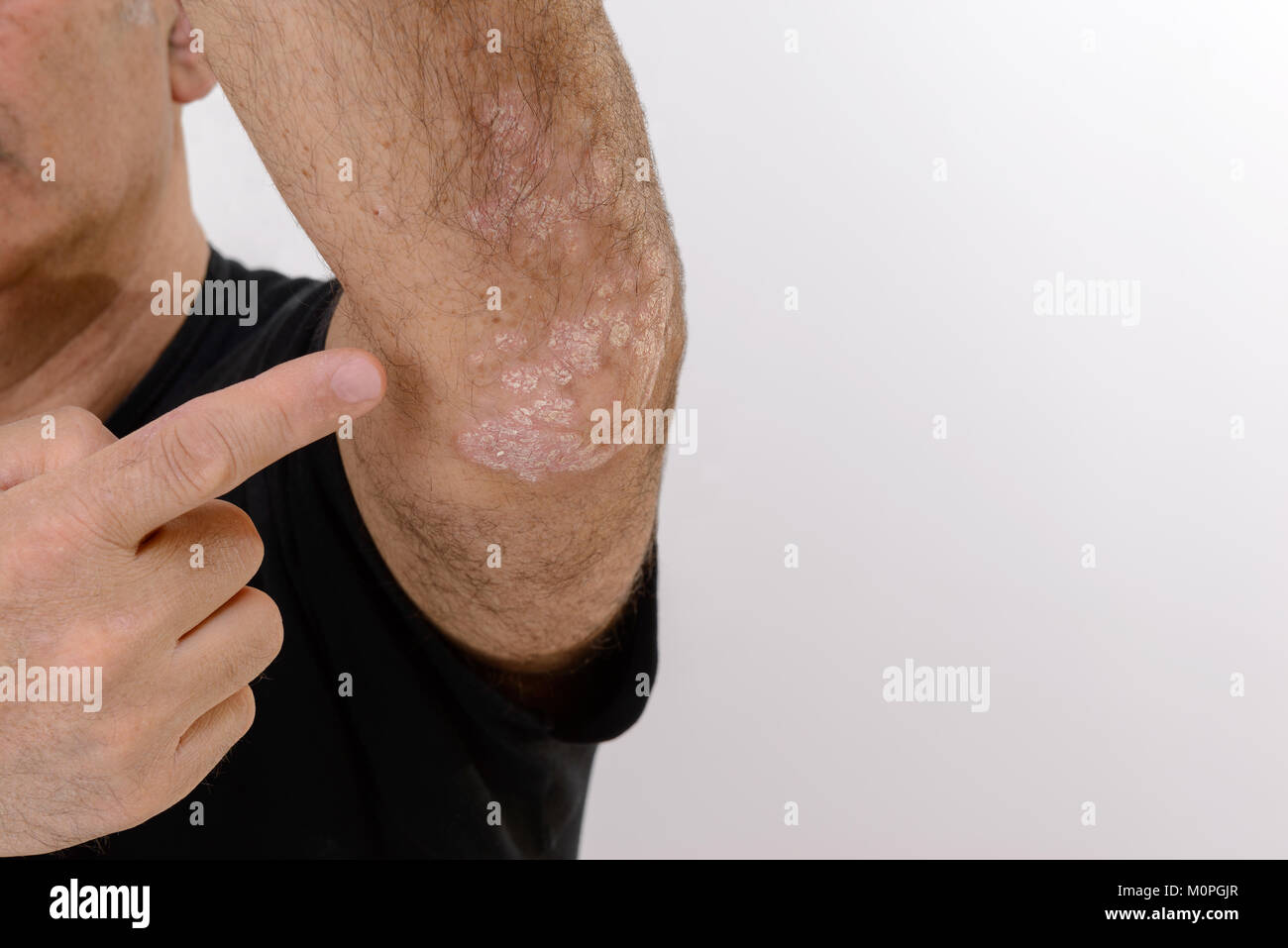 Chronic eczema hi-res stock photography and images - Alamy