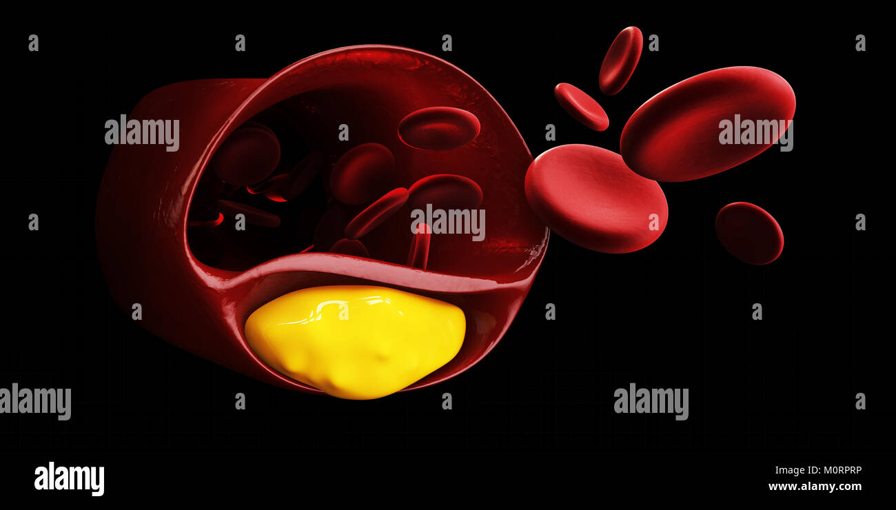 3d Illustration of human cardiovascular system with blood cells with plaque buildup of cholesterol symbol of vascular illness. isolated Black Stock Photo