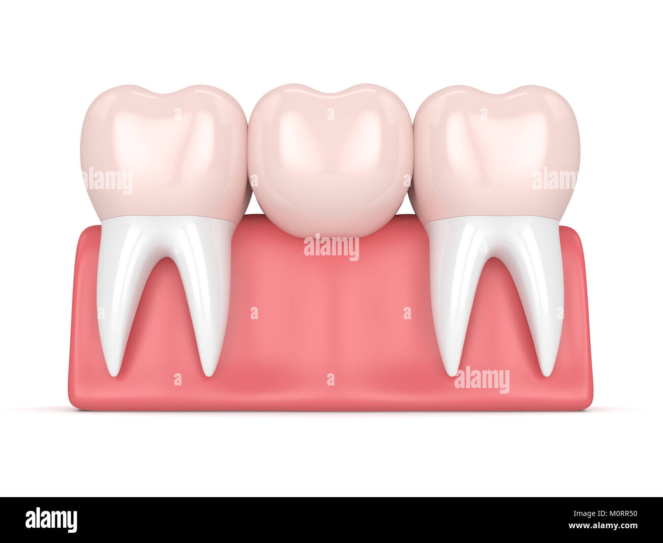 3d render of dental bridge with dental crowns in gums isolated over