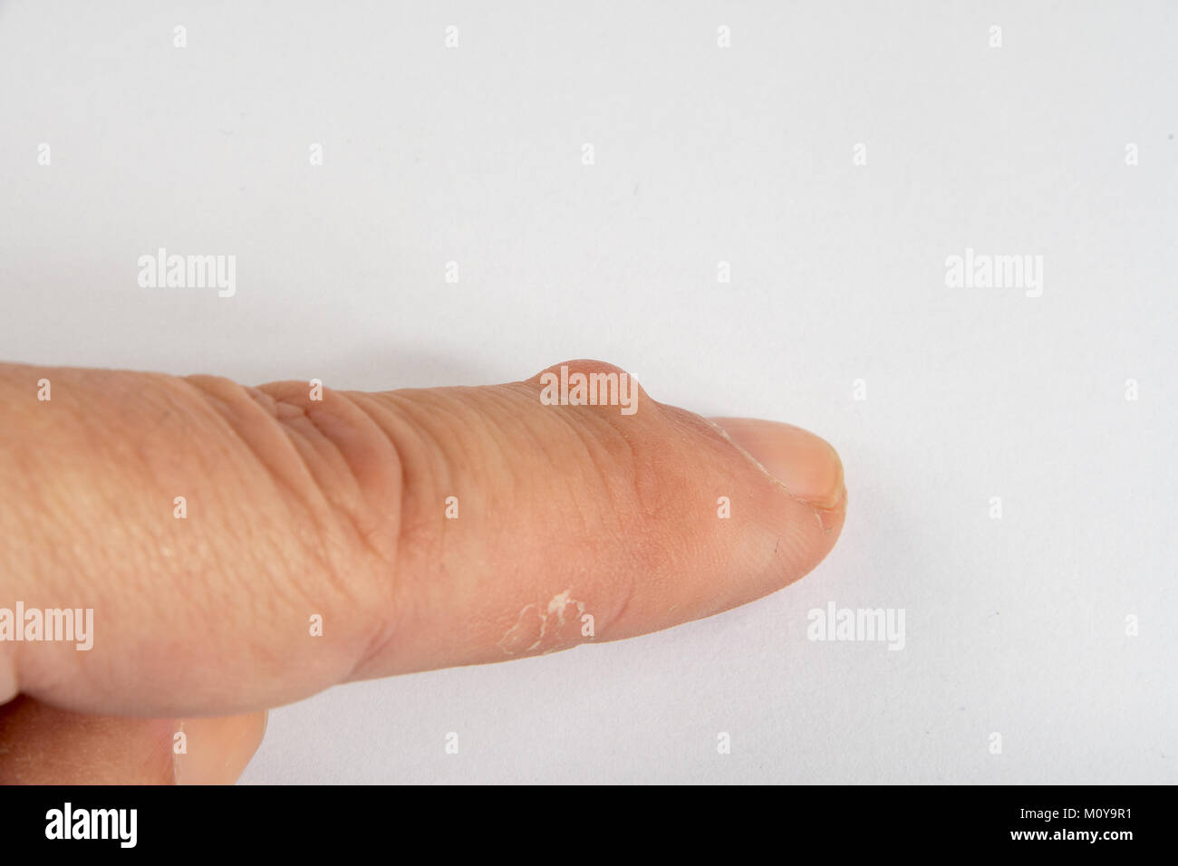 Ganglion cyst hires stock photography and images Alamy