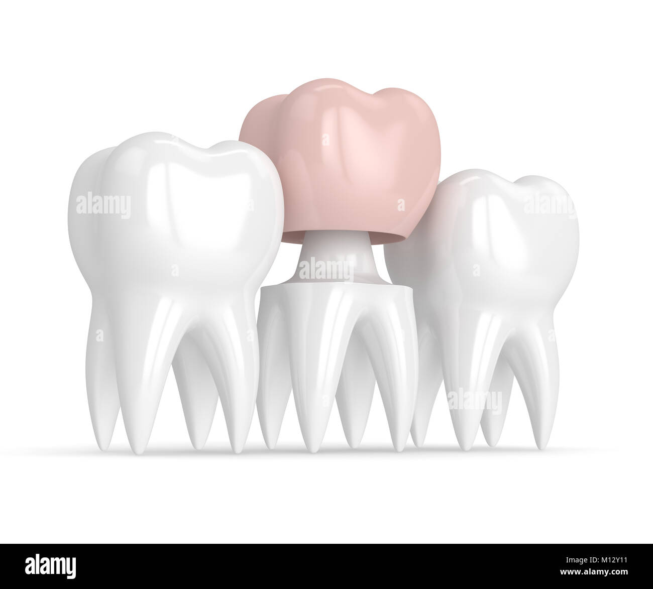 3d render of teeth with dental crown restoration over white background ...