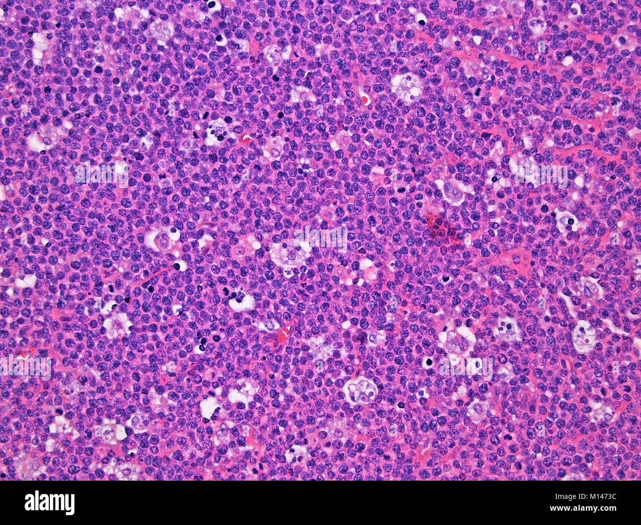 Burkitt Lymphoma in the Lymph Nodes Viewed at 300x Magnification with Haemotoxylin and Eosin Staining Stock Photo
