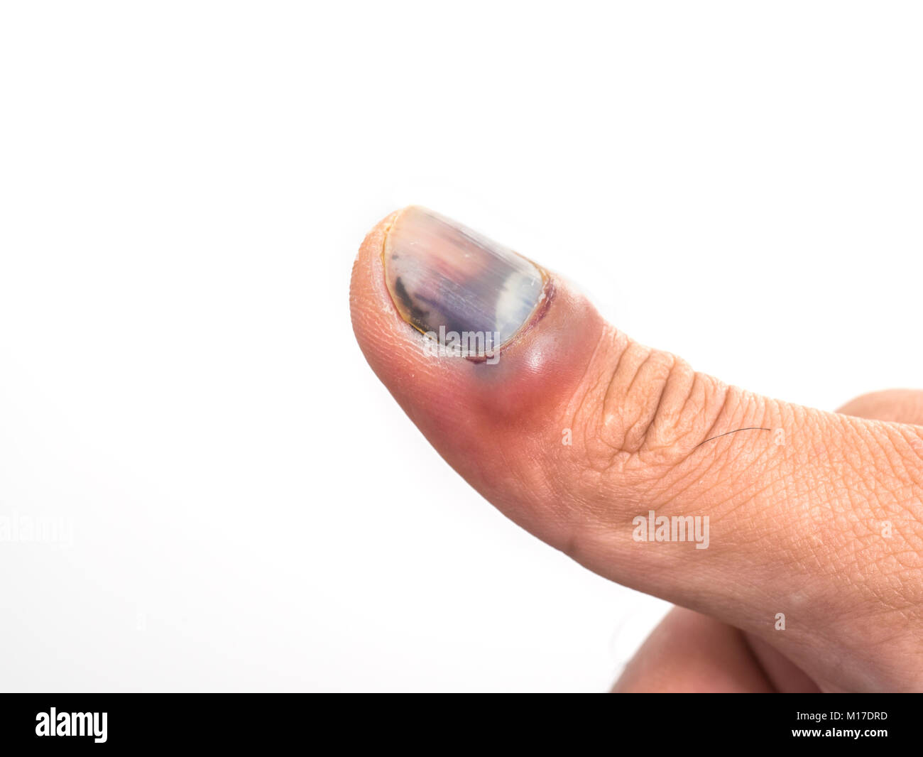 Bruised fingernail hires stock photography and images Alamy