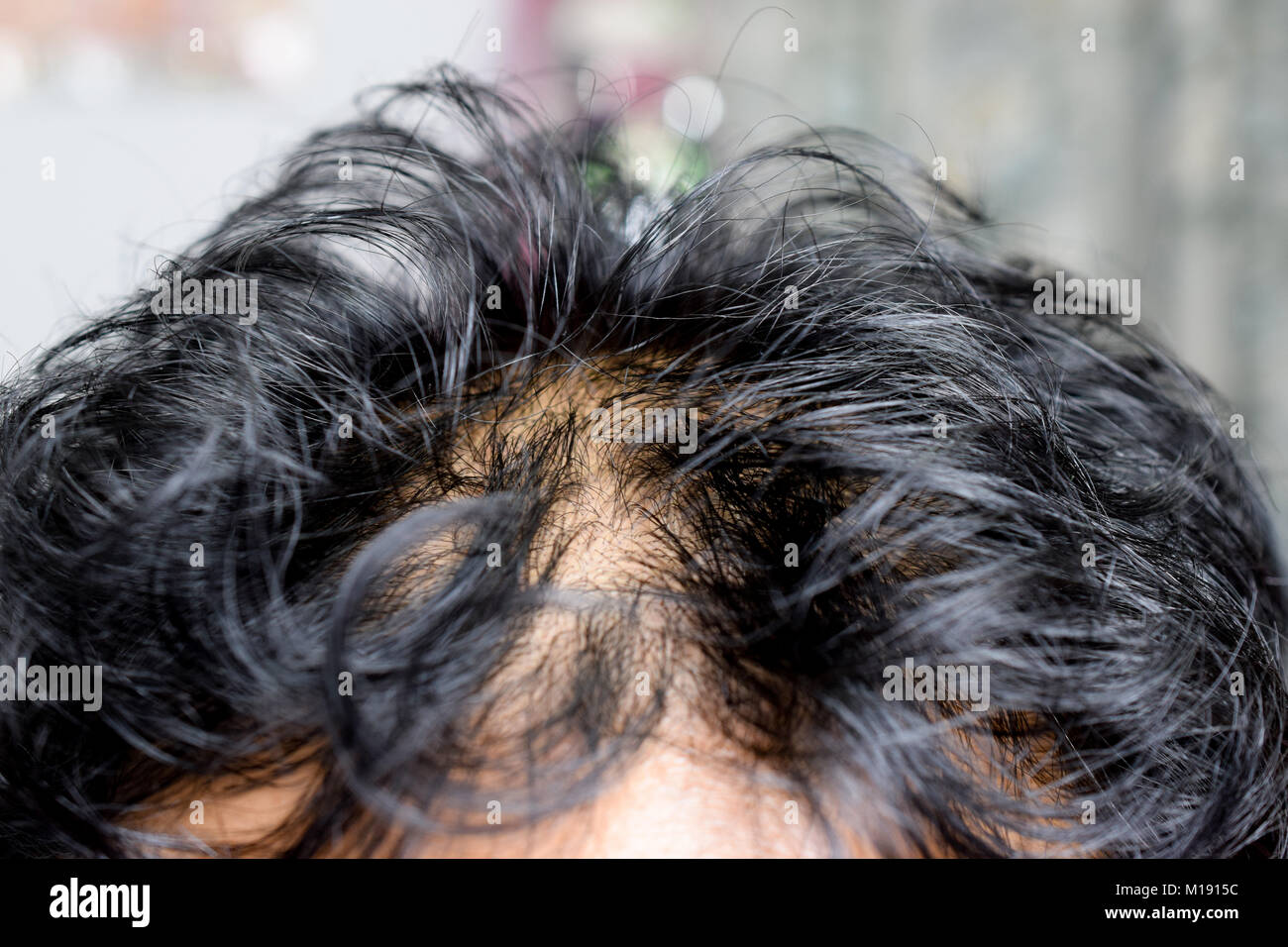 Thinning Hair And Scalp Stock Photos Thinning Hair And Scalp