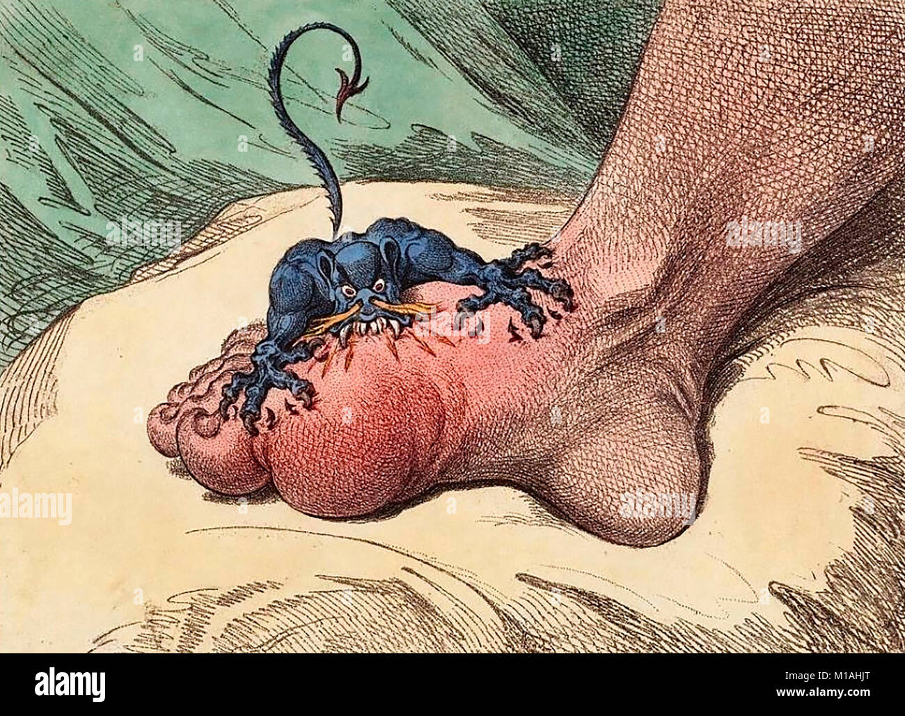 The Gout by James Gillray - Illustration showing the painful attack of gout Stock Photo