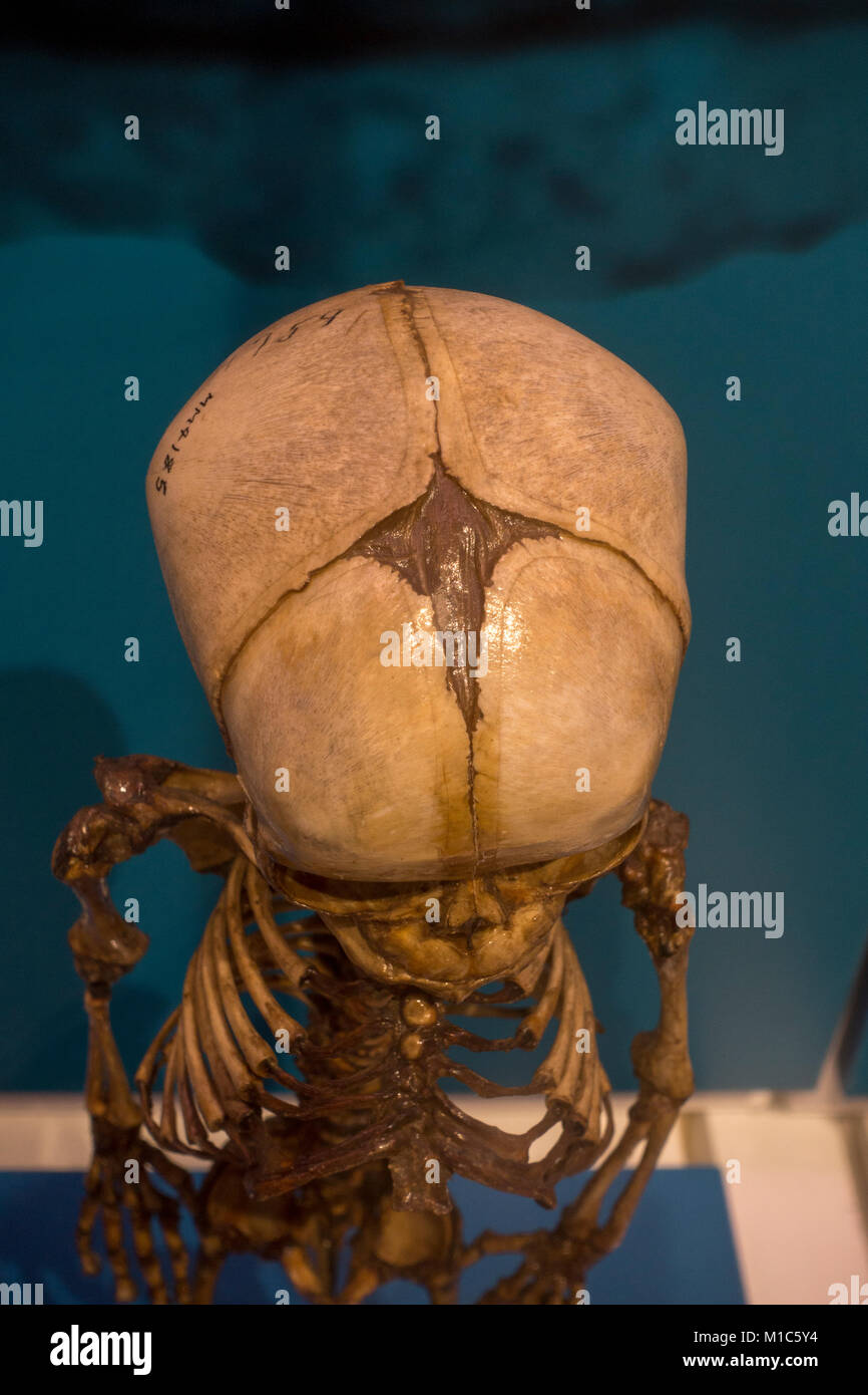 Sagittal suture hi-res stock photography and images - Alamy