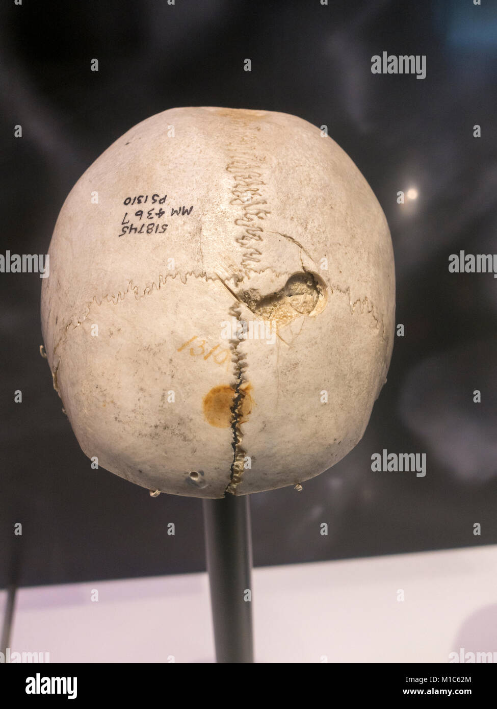 Cranial trephination from the Civil War era on display in the National Museum of Health and Medicine, Silver Spring, MD, USA. Stock Photo