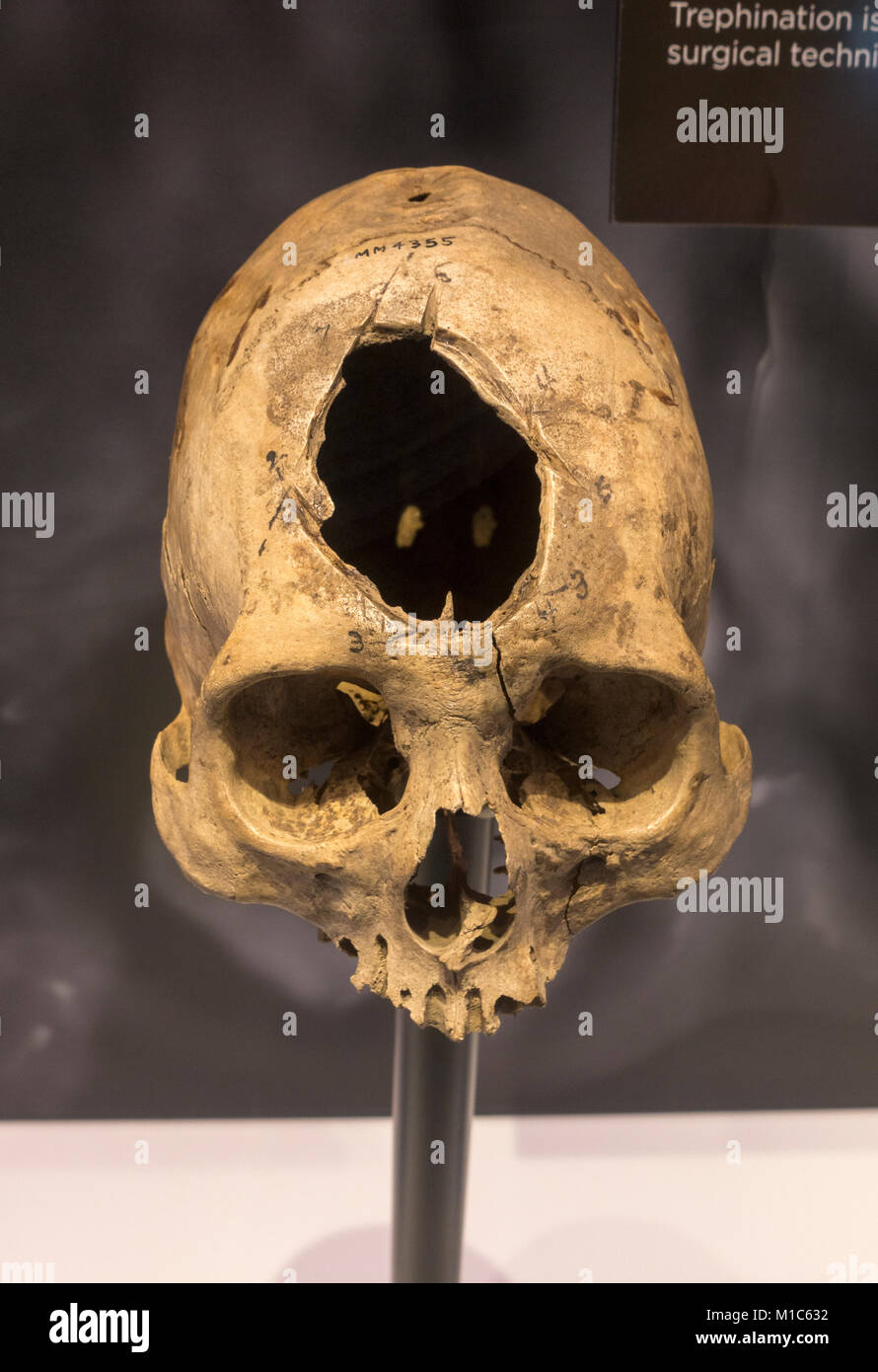 Cranial trephination, pre-Columbian Peru example on display in the National Museum of Health and Medicine, Silver Spring, MD, USA. Stock Photo