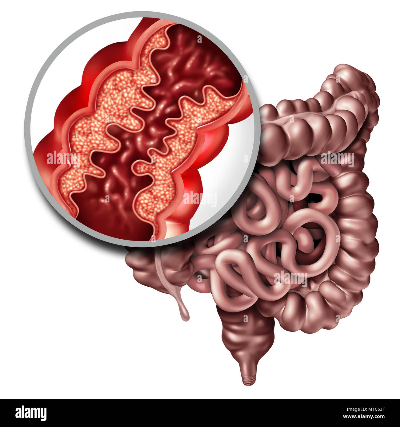 Crohnâ€™s disease or crohn illness medical concept as a close up of a human intestine with inflammation symptoms causing obstruction. Stock Photo