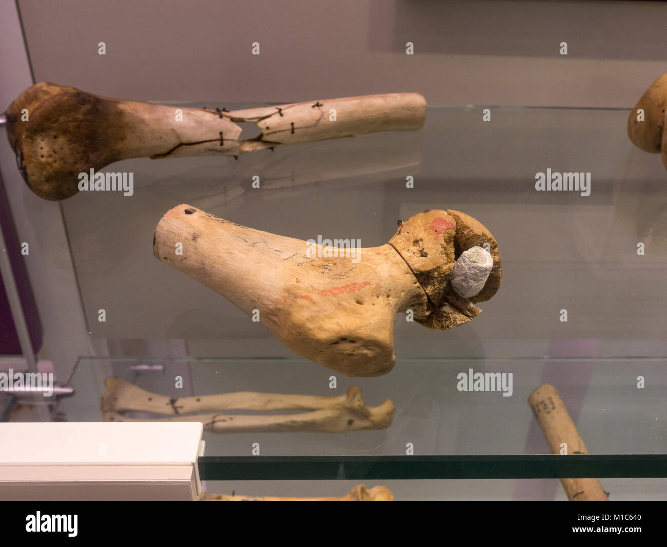 American Civil War human femur joint with the remains of a bullet on display in the National Museum of Health and Medicine, Silver Spring, MD, USA. Stock Photo