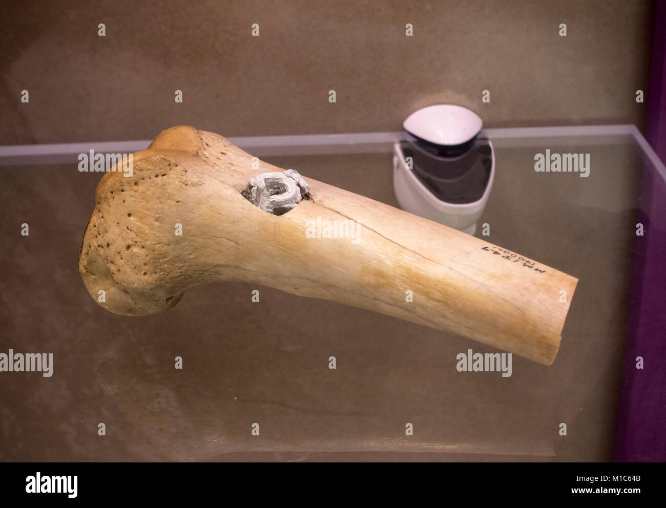 American Civil War human femur with the remains of a bullet on display in the National Museum of Health and Medicine, Silver Spring, MD, USA. Stock Photo