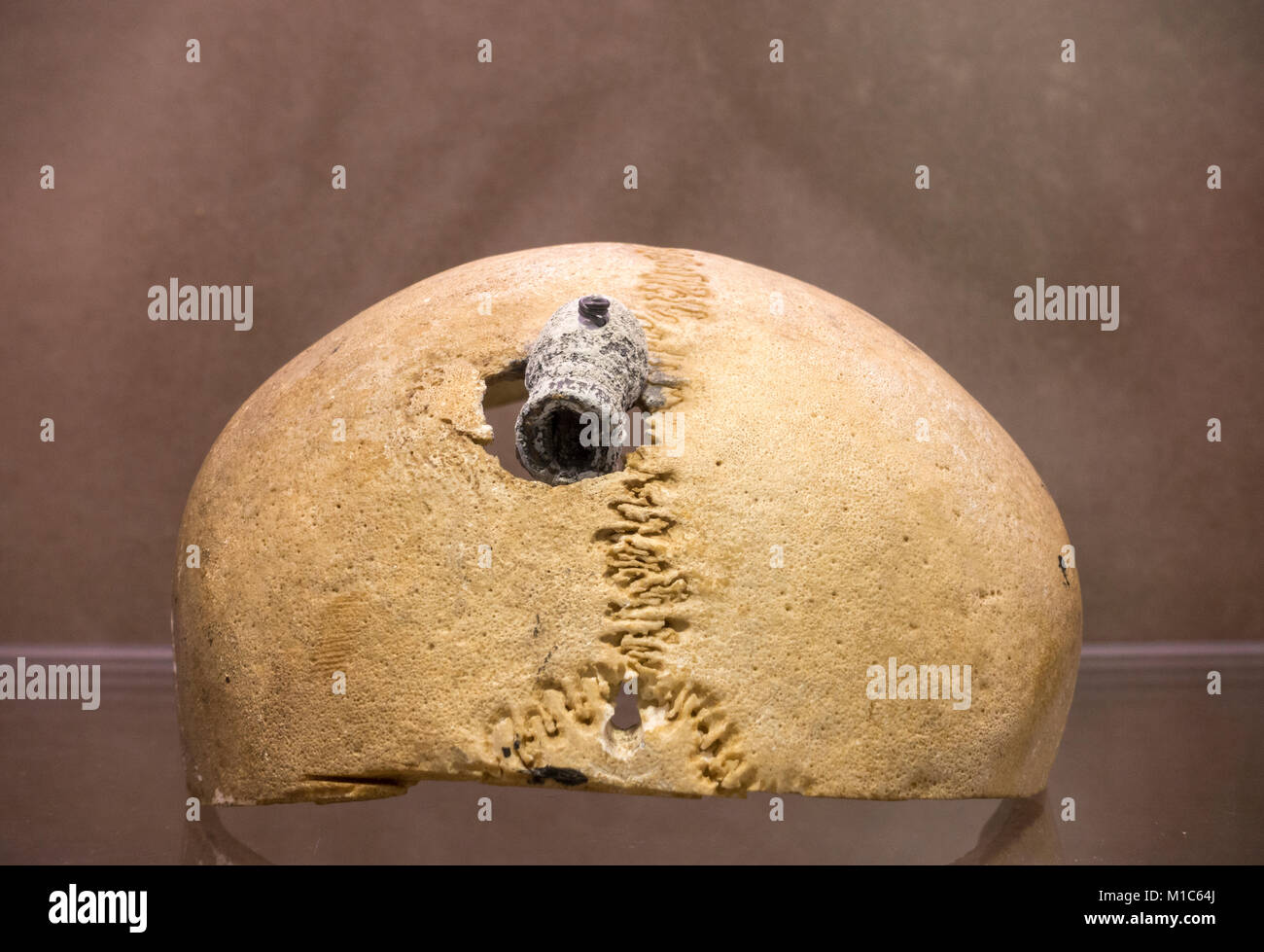 American Civil War human skull with the remains of a bullet on display in the National Museum of Health and Medicine, Silver Spring, MD, USA. Stock Photo