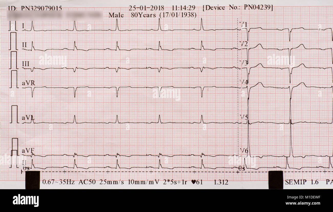 ECG printout for 80 year old male heart patient. Stock Photo