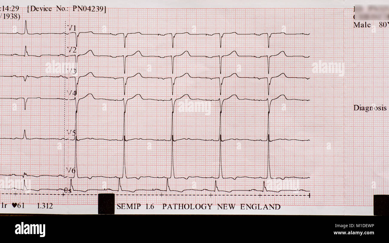ECG printout for male heart patient. Stock Photo