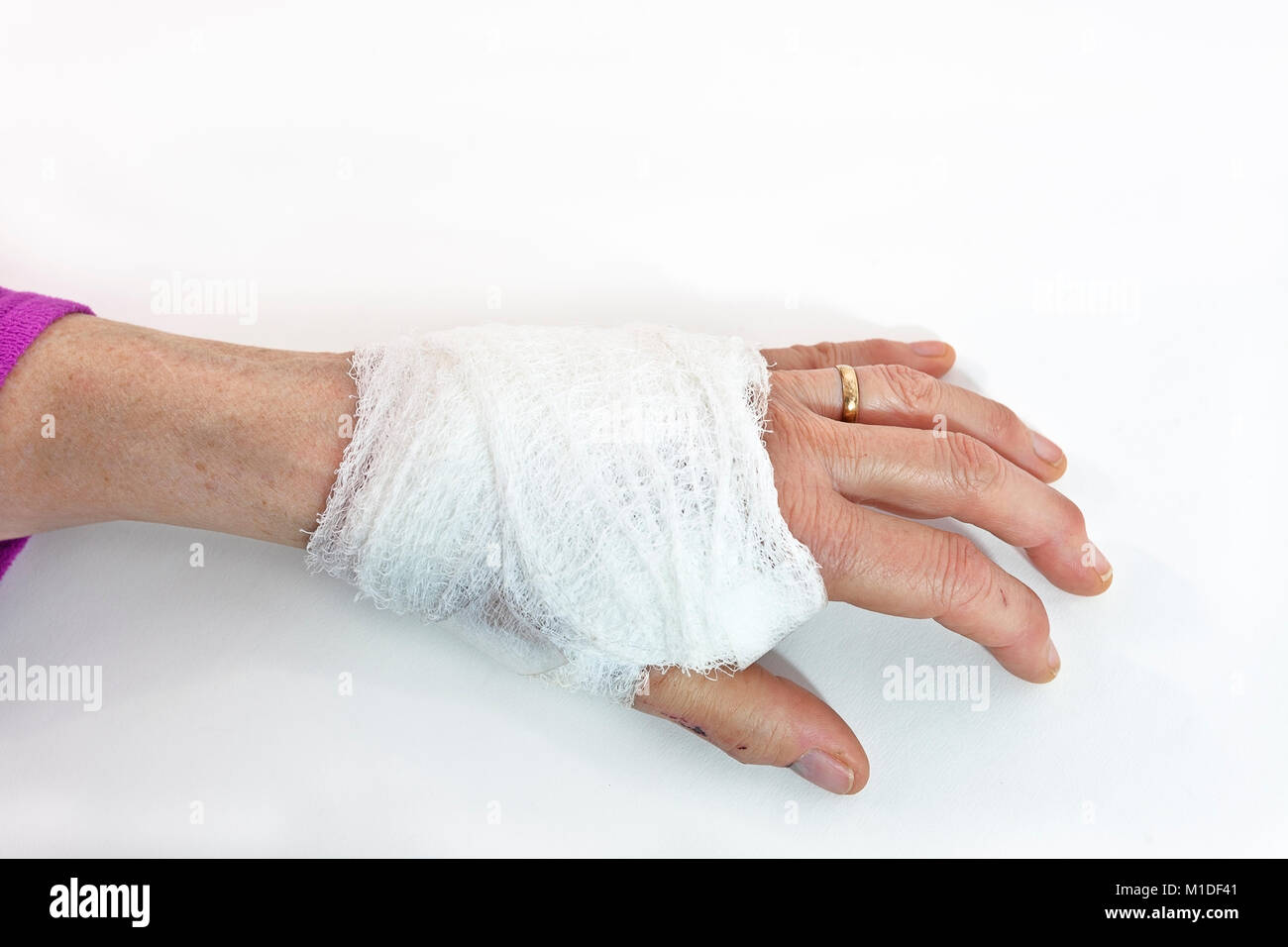 Bandaged female hand. Stock Photo