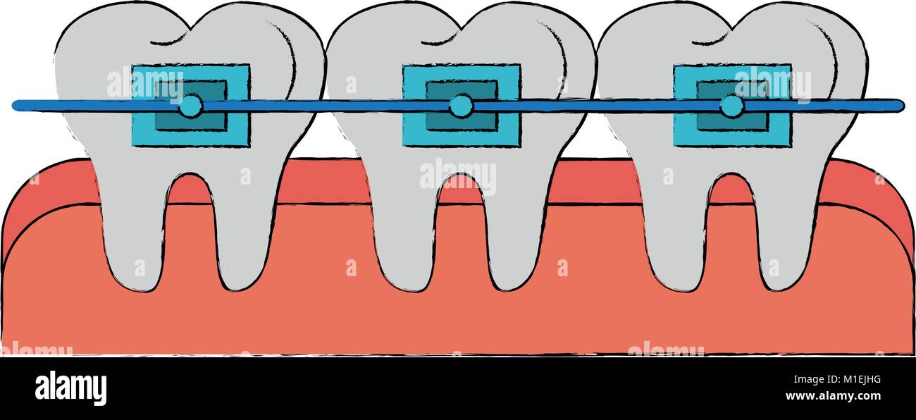 Teeths with brackets Stock Vector Image & Art - Alamy