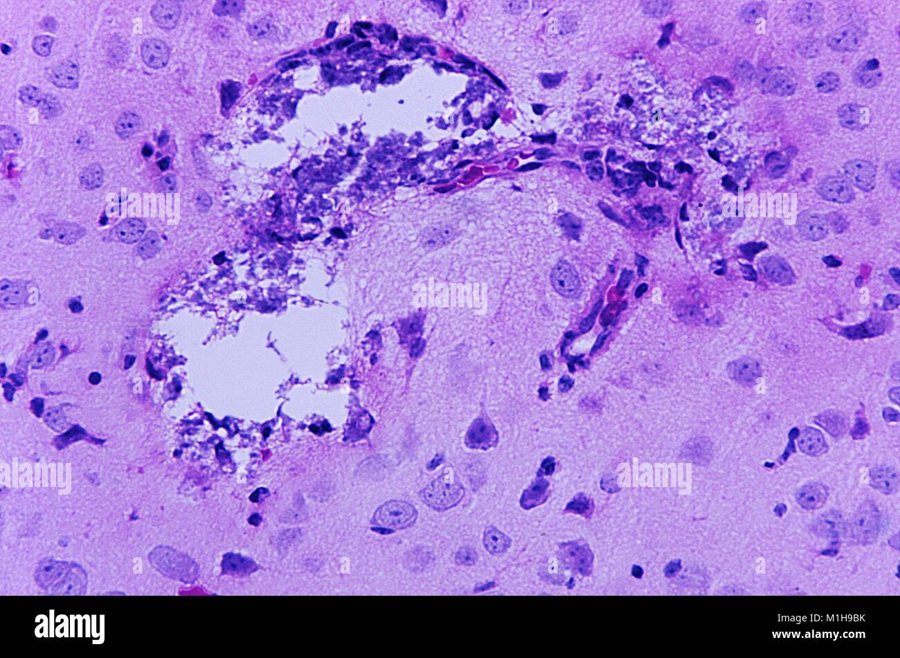 Histopathologic changes found in Tamiami virus encephalitis revealed in a micrograph film, 1972. Image courtesy Centers for Disease Control (CDC) / Dr W Winn. () Stock Photo